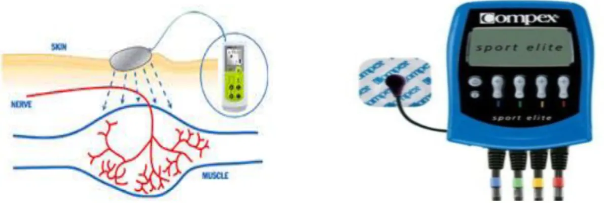 Figure .I.18:l’électrostimulation d’un muscle [14]   Figure .I.19 : stimulateur [15] 