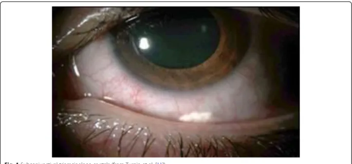 Fig. 1 Subconjunctival triamcinolone crystals (from Turpin et al. [11])