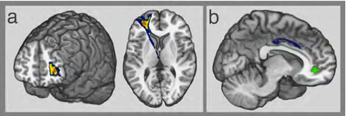 Figure 3. Disconnection-deficit mapping. The disconnection-deficit map of the CAT-index score (P &lt; 0.05,  FWE-corrected) (a) and of the FGAT-distant commonness of responses (P &lt; 0.001, uncorrected) (b) are 