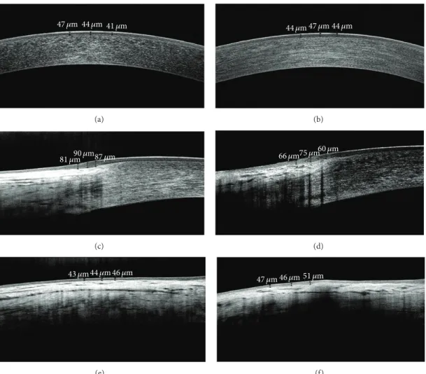 Figure 1: SD-OCT images of ocular surface epithelial thickness measurement in a healthy control subject (a, c, e) and a dry eye patient (b, d, f)