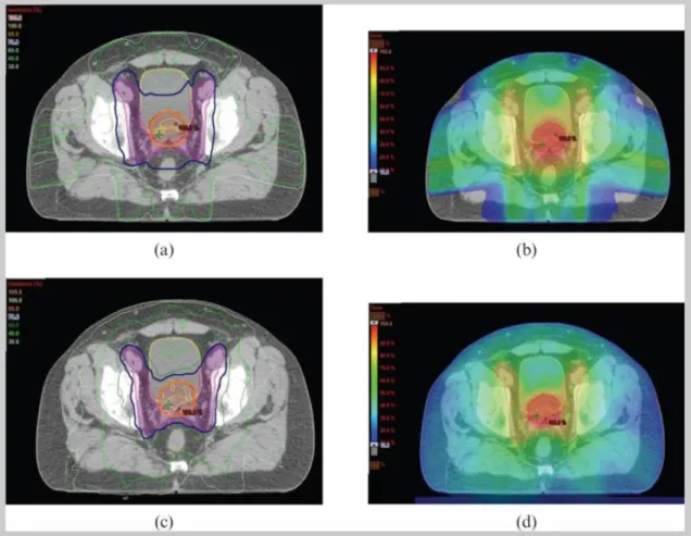 Figure 2-4: Example of dose distributions in IMRT (a,b) and VMAT (c,d) plans for radiotherapy to the prostate and pelvic lymph nodes