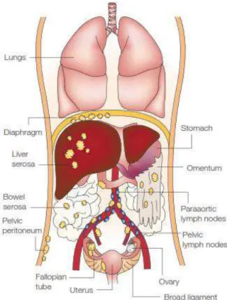 Figure 2 : dissémination du cancer de l’ovaire [4]. À l’étape précoce (étape IA / IB), la tumeur  (représentée par les masses jaunes sur la figure) est limitée à un ou deux ovaires, la capsule ovarienne est  intacte, et aucune tumeur n’est présente sur la 