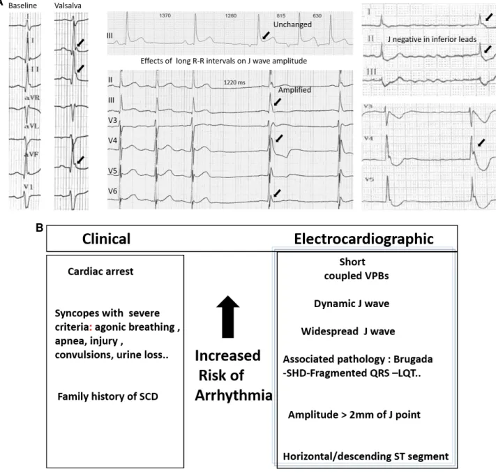 Figure 1: (A) ECG variations in inferolateral J-Waves. Left: Valsalva or strong inspiration maneuver producing J-wave amplification