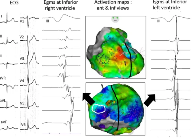 Figure 3: Inferolateral J-wave syndrome due to abnormal depolarization. The maps (center) show activation mapping with blue indicating the latest  acti-vated regions; herein the inferobasal right and left ventricles