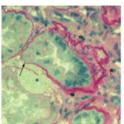 Figure 1 : Aspects histologiques de la néphronophtise. Coloration au Periodic Acid Schiff (PAS) de  coupes de reins de patients atteints de néphronophtise