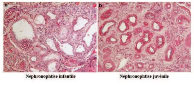 Figure 2 : Les patients atteints de NPH infantile peuvent présenter une histologie de NPH type 