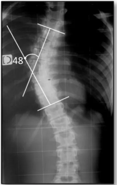 Figure 13: Mesure de l’angle de Cobb sur la radiographie de face d’une scoliose idiopathique de l’adolescent