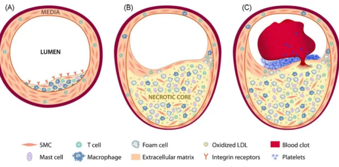 Figure  I-30.  The  atherosclerosis  progression.  A:  An  early  stage  of  atherosclerosis  characterized  by  intima  xanthomas;  ECs  activation,  VSMC  phenotype  switch,  monocytes/macrophages  presence  and  foam  cells  formation