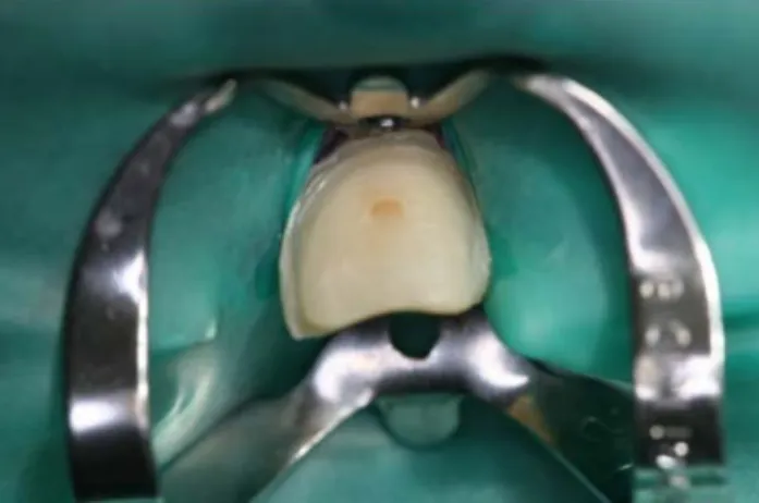 Figure 11. Digue dentaire utilisée en barrage à la salive lors du collage d’une  facette [23]