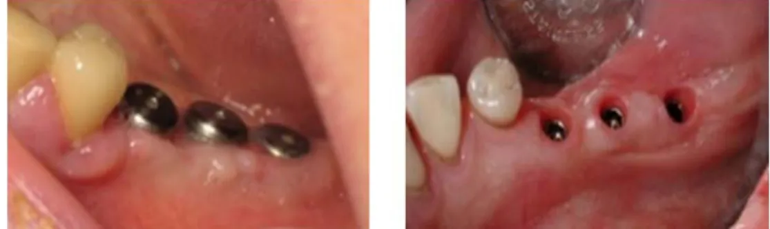 Figure 14. Implants dentaires avec et sans leurs vis de cicatrisation [26]. 