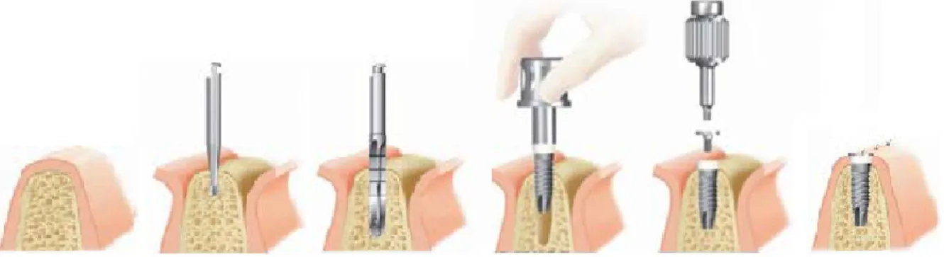 Figure 16. Mise en place d'un implant dentaire en un temps opératoire [27]. 