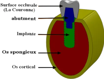 Figure 1. Représentation de l’assemblage implant/prothèse dentaire en vues  éclatées. 
