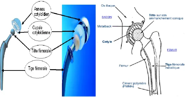 Fig. I-7 : Eléments constituant une prothèse totale de hanche modulaire. 