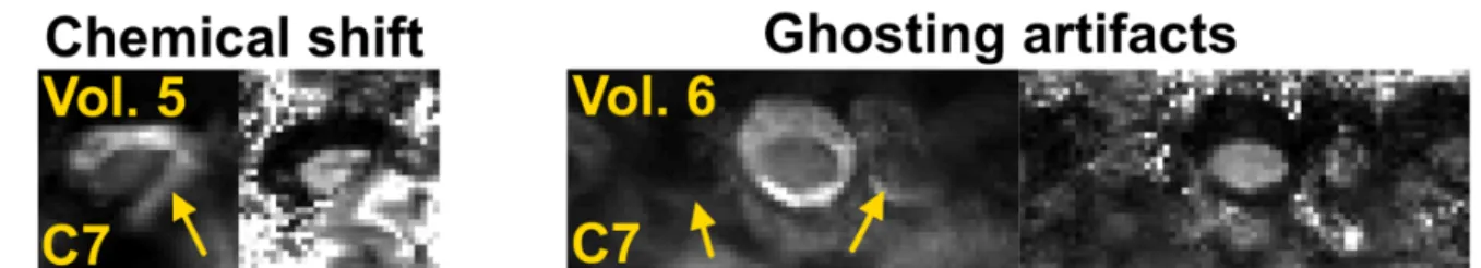 Figure 3.  Illustration of artifacts encountered at the C7 level on two volunteers. EPI images  with b-value = 0 s/mm 2  (left columns) and corresponding FA maps (right columns)