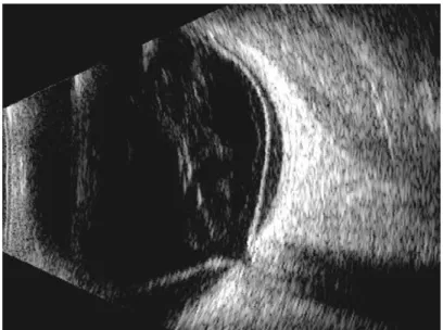 Figure 1.3 : Echographie oculaire 4