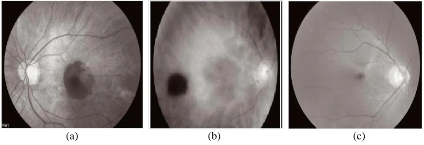 Figure 1.4 : Angiographie à la fluorescéine rétinienne en trois couleurs 5                                                  