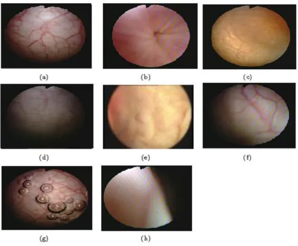 Figure 1.14 : Quelques exemples d‟images pouvant être extraites d‟une séquence vidéo  cystoscopique 18 