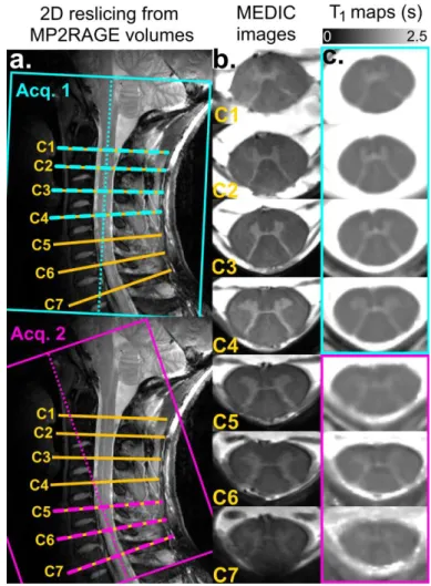 Figure 2: MR imaging results on healthy volunteer #8. a: MP2RAGE first (cyan) and second  (purple)  volume  orientations  are  indicated  on  sagittal  TSE  images