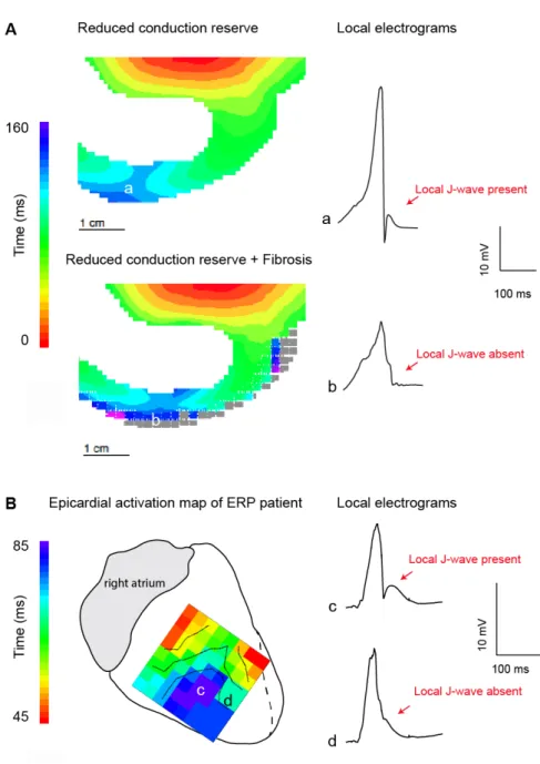 Figure 2. Local J-wave and excitation failure in relation to the early repolarization syndrome