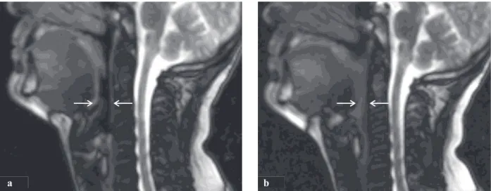 Fig. 14 Coupes sagittales médianes cervico-faciales chez un sujet témoin (N°9) en mode True-FISP, séquence pondérée en                 T2