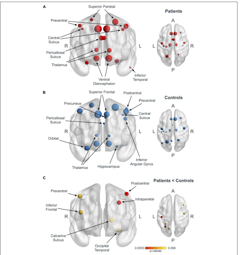 FIGURE 2 | Hubs in ALS patients and controls. Panels (A,B) represent coronal and axial views illustrating the hubs in patients (A, red) and controls (B, blue)