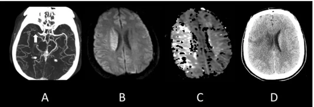 Figure 16 : AVC ischémique au niveau de l'artère cérébrale moyenne droite chez un homme de 38 ans