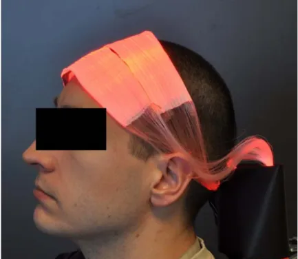 Figure  9:  LEF  used  in  a  phase  II  study,  comparative,  randomized,  open‐label,  multicenter  evaluation of  photodynamic therapy treatment of actinic keratosis 