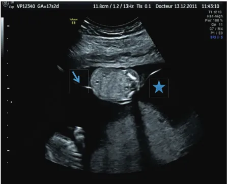 Figure 3 : Signe échographique du STT chez une patiente de 17 SA + 2 jours. L’un des jumeaux présente un  oligoamnios (fœtus situé le plus haut sur l’image)