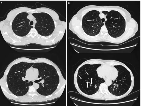 Figure 4.  Pedigree of family 2 with SFD and late moderate pulmonary disease linked to c.113C  &gt; G TIMP3  mutation
