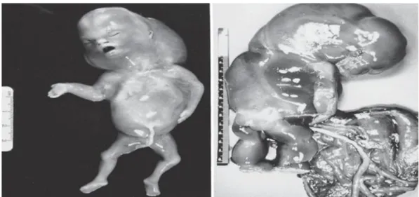 Figure  2 :  Deux  embryons  avortés  spontanément  avec  un  caryotype  45,X0  (monosomie  X) ,  à  gauche,  un  embryon de 10 semaines avec hygroma et à droite, un embryon avec placenta hypoplasique  (Benirschke, 2006) 