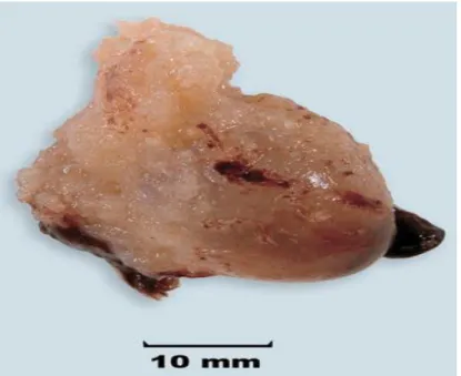 Figure 5 : Groupe I : un fœtus avorté pendant la  8 ème  semaine de gestation sans pièces fœtaux identifiables (œuf  clair) (Yee khong, 2007)