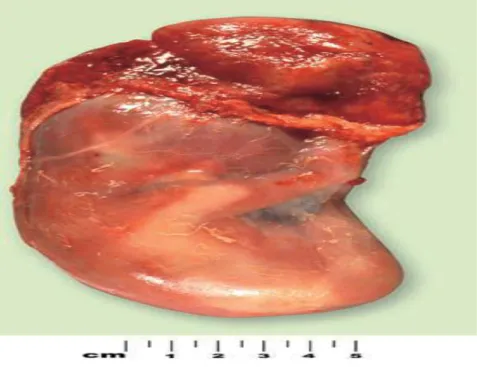 Figure 7 : Groupe III : Fœtus avorté pendant la 19 ème  semaine de gestation. Le fœtus se trouve intact en dessous  du sac gestationnel (Yee khong, 2007)