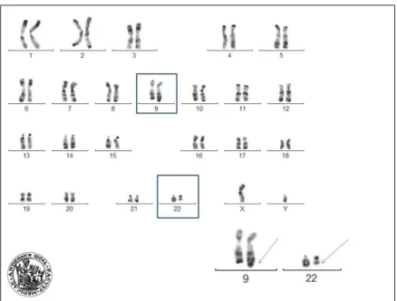Figure 1.15 – Caryotype d’un patient atteint de LMC, on identifie la translocation t(9-22), avec un chromosome 22 raccourci (chromosome Philadelphie) et un  chromo-some 9 allong´ e [14].