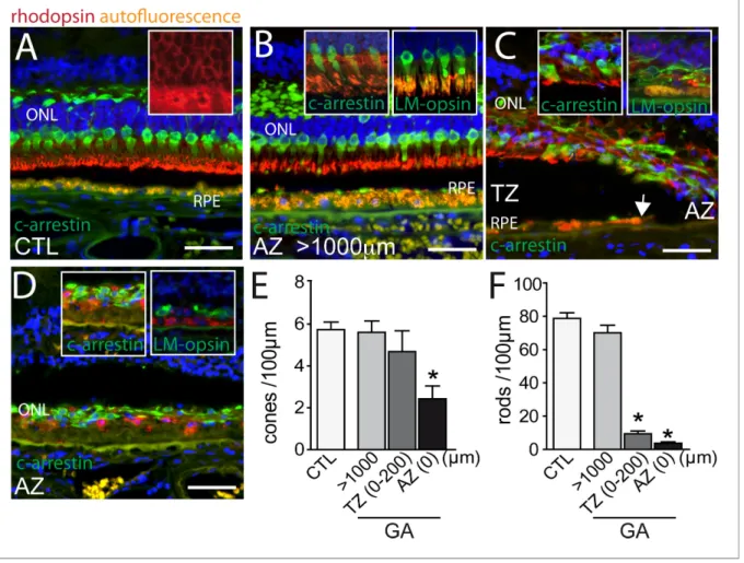 Figure 1. Rhodopsin, cone arrestin, and L/M cone opsin staining on central sections from control and geographic atrophy patients