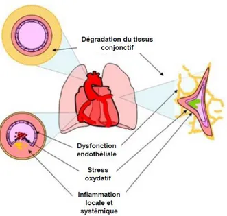 Figure 2 : Physiopathologie de la BPCO et des maladies coronariennes, d‘après MacNee W