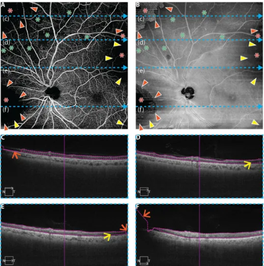 Figure 4.  Illustration of cross-sectional, en face, and orthoplane approaches for artifact detection in an  eye from a 68 year-old with mild NPDR; same eye as in Fig. 3