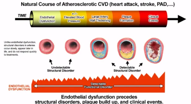 Figure  6.  Endothelial  dysfunction  as  an  early  indicator  in  the  initiation  and  progression  of  atherosclerosis (© Cenegenics Medical Institute of Phoenix, AZ)