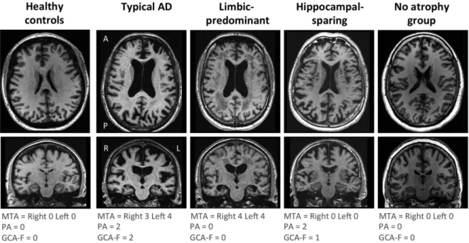 Figure 6 : Distinction des différents sous-types de MA basés sur le profil d’atrophie cérébrale à partir  d’échelles d’atrophie (d'après Ferreira et al., 2017) 