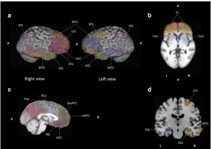 Figure 18 :  Représentation graphique des corrélats neuronaux de l’anosognosie chez des patients  MA à un stade léger à modéré (d’après la méta-analyse de Mondragón et al., 2019) 
