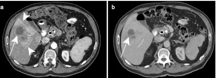 Fig. 1    Pyogenic abscess in a 60-year-old female patient with a history  of chronic pancreatitis who presented with asthenia and fever