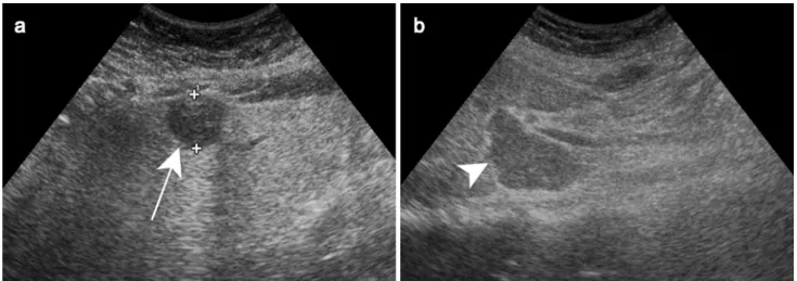Fig. 2    Liver tuberculosis in a 49-year-old female patient with asthe- asthe-nia and loss of weight without fever