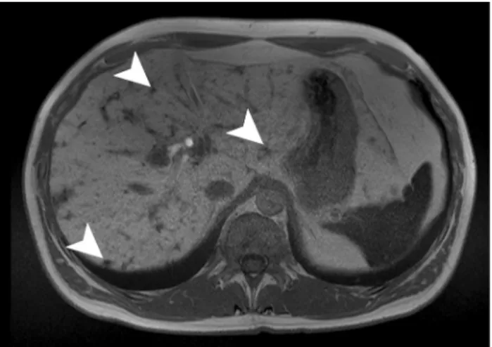 Fig. 7    Candidiasis in a 65-year-old male patient with acute myelo- myelo-blastic leukemia