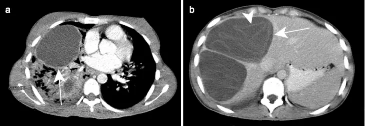 Fig. 9    Cystic echinococcosis type CE3a in a 27-year-old female  patient with cough
