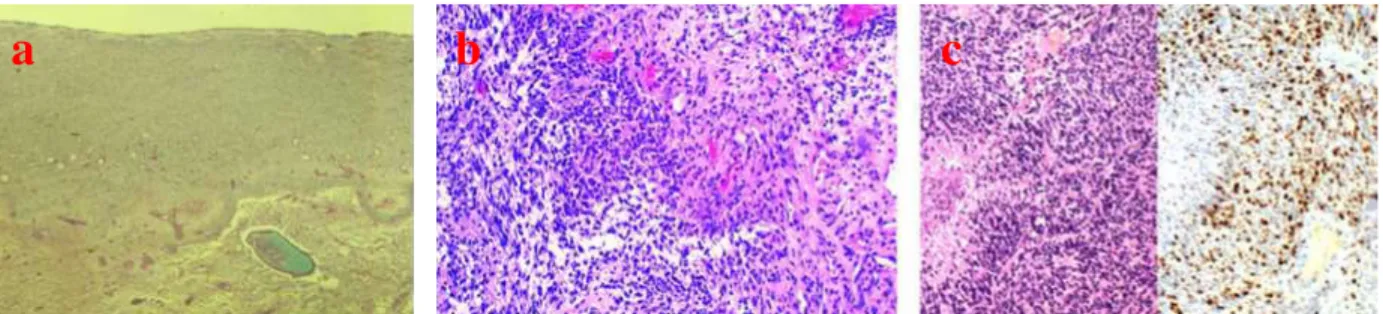 Figure 1.3 Histologic characteristics of glioblastoma tumors. (a) Three zones can be recognizedμ central necrosis,  proliferation, and infiltration zone