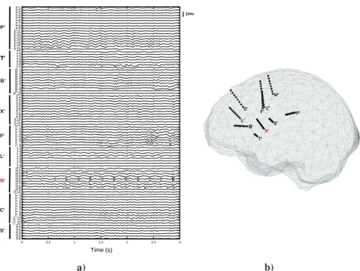 Figure 7: a) SEEG signals of interictal spikes in common reference montage (FPz scalp electrode)