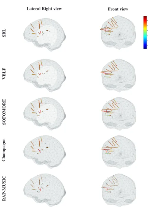 Figure 8: Localization maps of averaged inter-ictal spikes (20 events) over a window length of 125ms (64 samples), centered on the maximum values of each spike (as recorded on the electrode R’6)