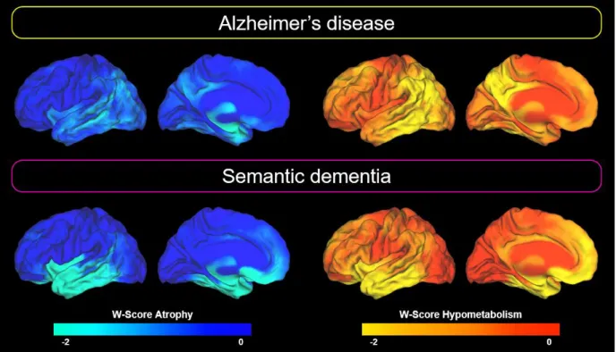 Figure 2: Patterns of brain alteration in patients with Alzheimer’s disease and semantic  dementia