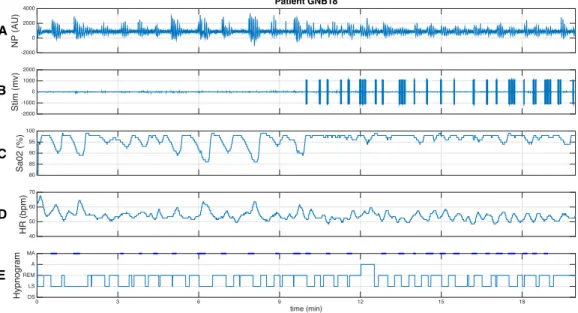 Figure 5: Cardiorespiratory response to kinesthetic stimulation of a responder patient
