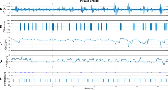 Figure 6: Cardiorespiratory response to kinesthetic stimulation of a partially responder patient