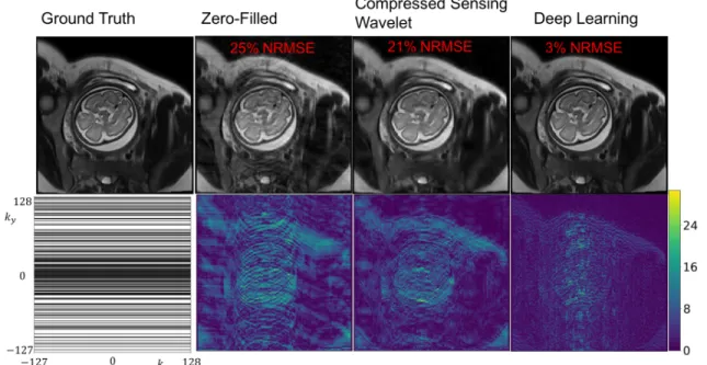 Figure 2-8: Sample reconstructions and error maps for acceleration factor of 2. Bot- Bot-tom left: k-space undersampling mask